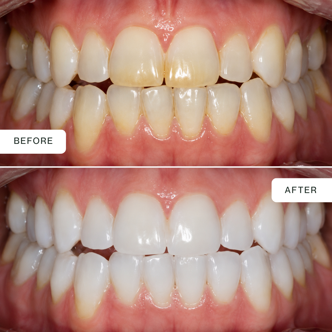 Pro Dual-Light Teeth Whitening Kit — Blue + Red LED