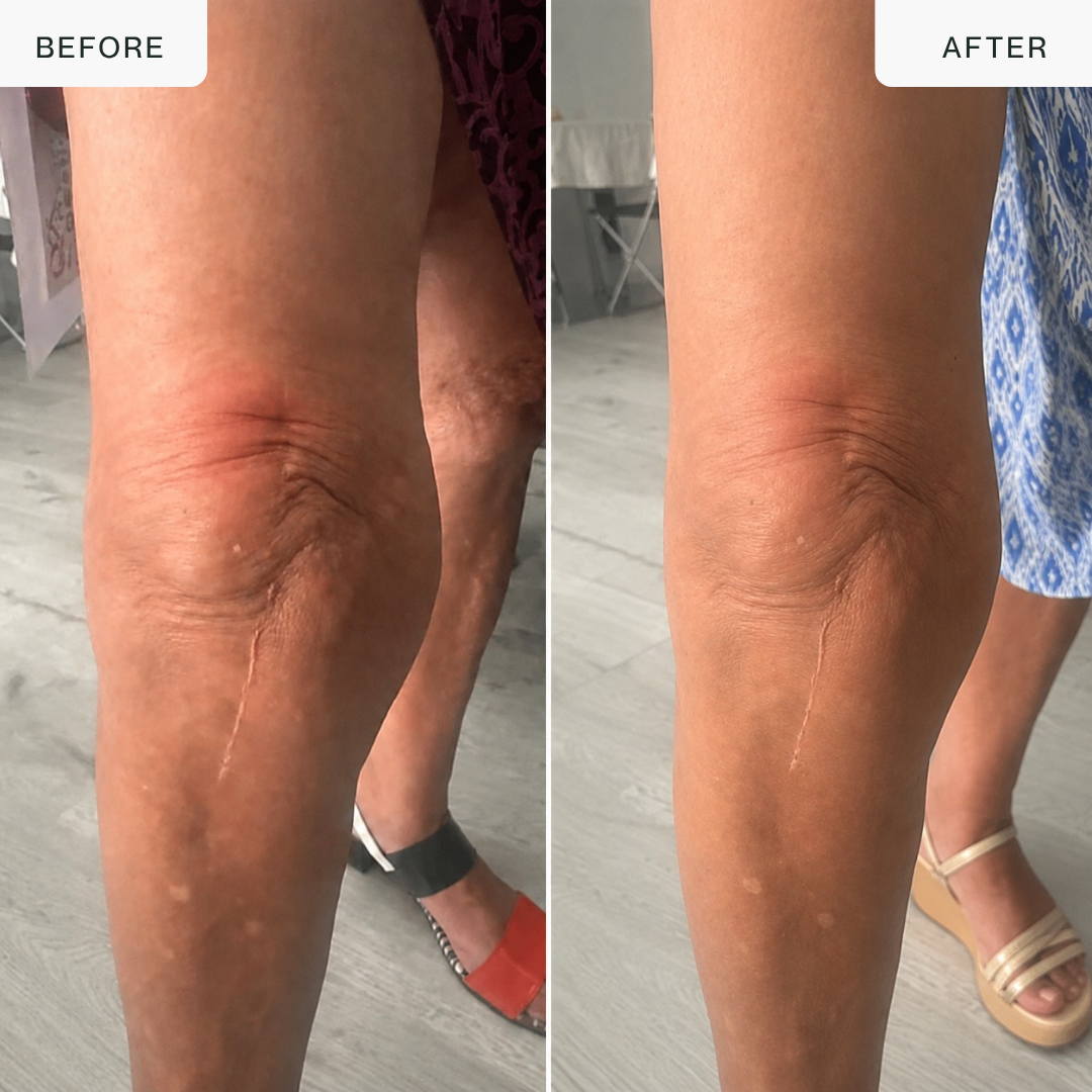 Cordless Knee Massager — Infrared, Heat, Vibration & Laser Therapy