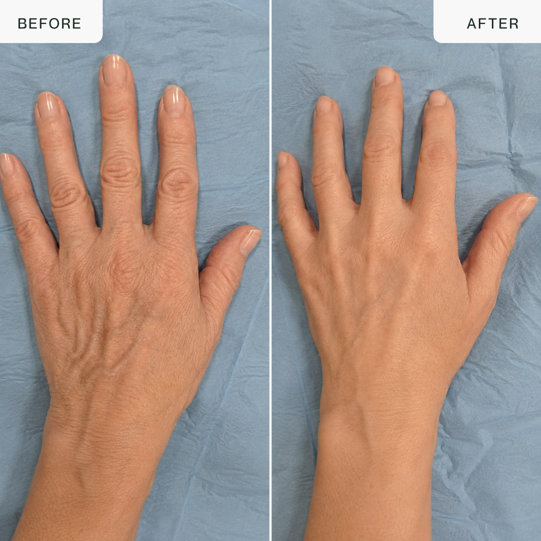 Hand Glow Pro — Triple-Wavelength LED Hand Rejuvenation