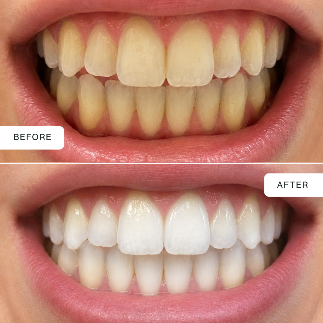 Pro Dual-Light Teeth Whitening Kit — Blue + Red LED