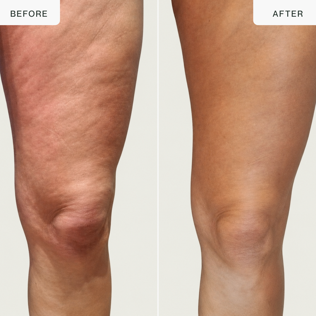 4-in-1 RF Body Sculptor — Cellulite, Firming & Toning