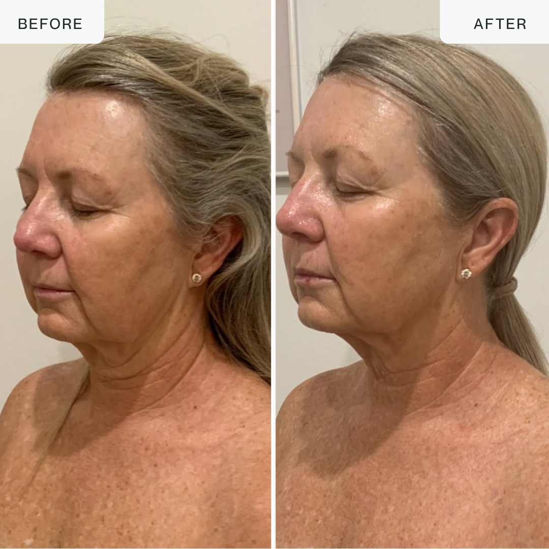 The Complete Anti-Aging LED Kit — Face, Neck & Décolleté Duo
