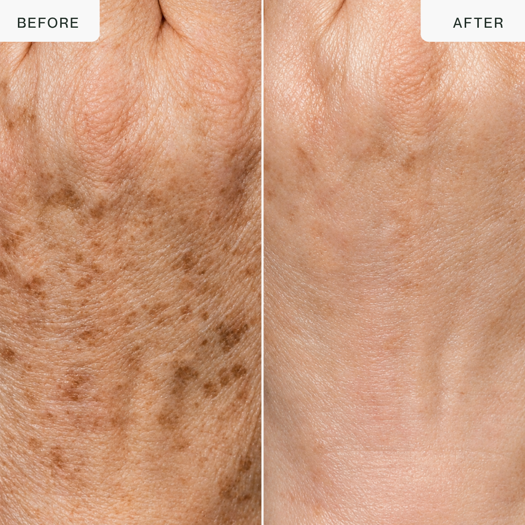 Hand Glow Pro — Triple-Wavelength LED Hand Rejuvenation