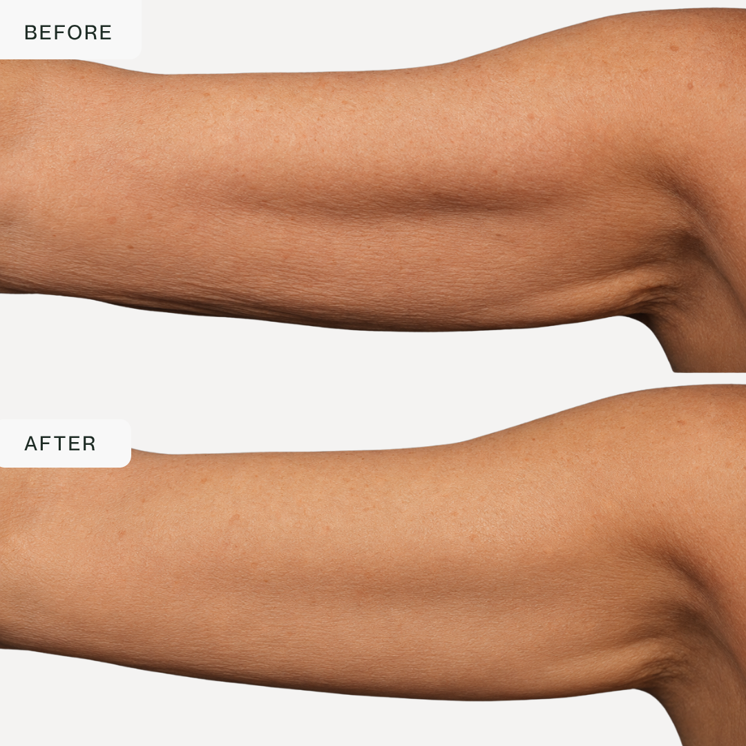 4-in-1 RF Body Sculptor — Cellulite, Firming & Toning