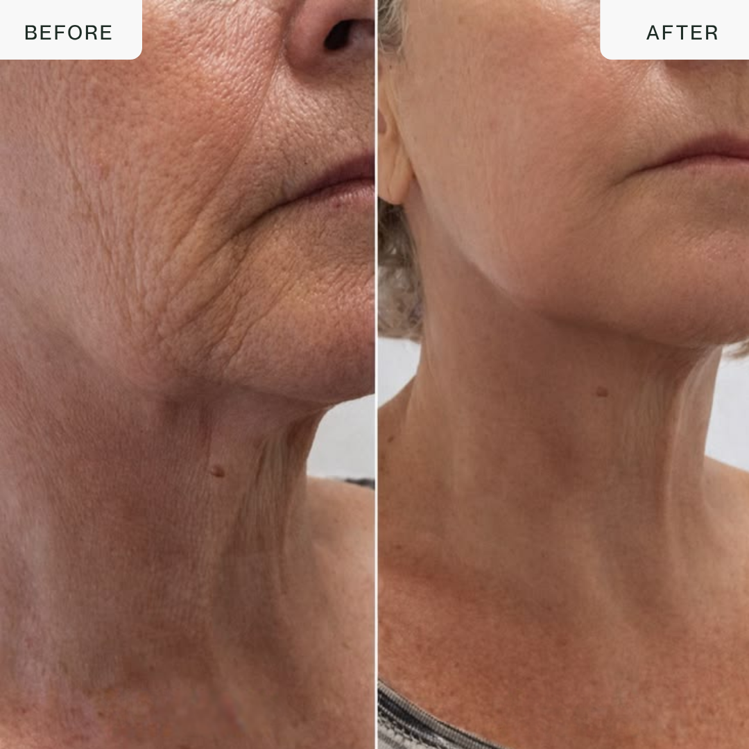 24K Gold RF Lifting Device — Face & Neck Sculptor