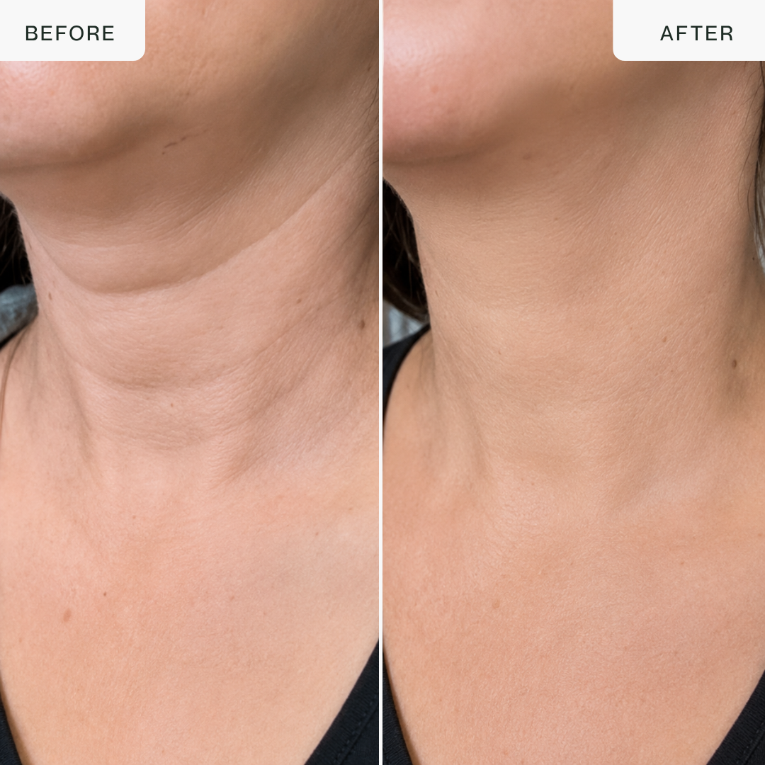 24K Gold RF Lifting Device — Face & Neck Sculptor