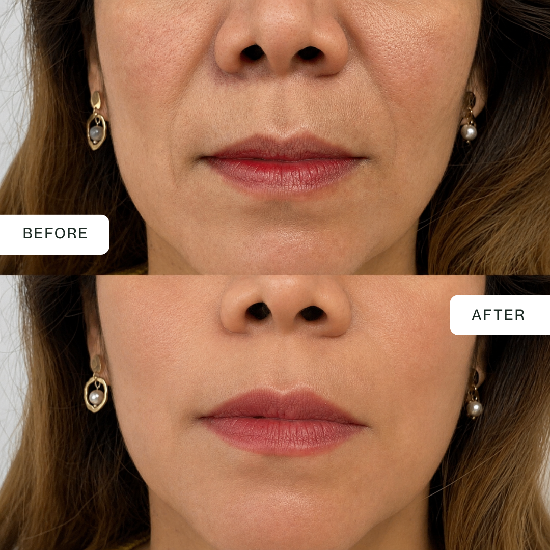 LED Lip Mask — 850nm Near-Infrared Lip Therapy