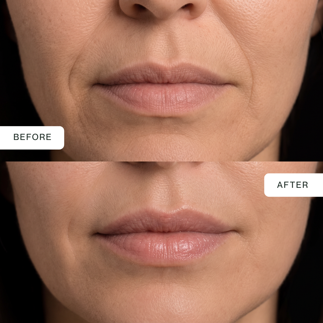 LED Lip Mask — 850nm Near-Infrared Lip Therapy